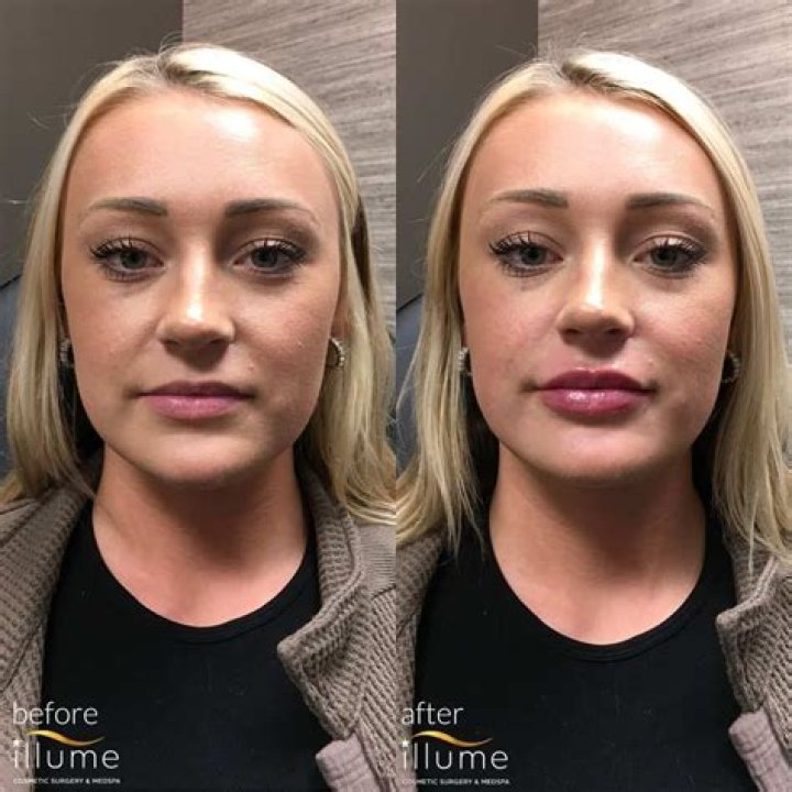 Ariana Madix’s Plastic Surgery: The Vanderpump Rules Star Claims to be a Natural Beauty Who Had Just Had Botox, Lip Fillers, and Jawline Surgery!